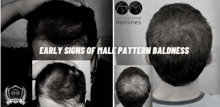 The Early Signs of Balding and How to Stop Them - SMP Blog